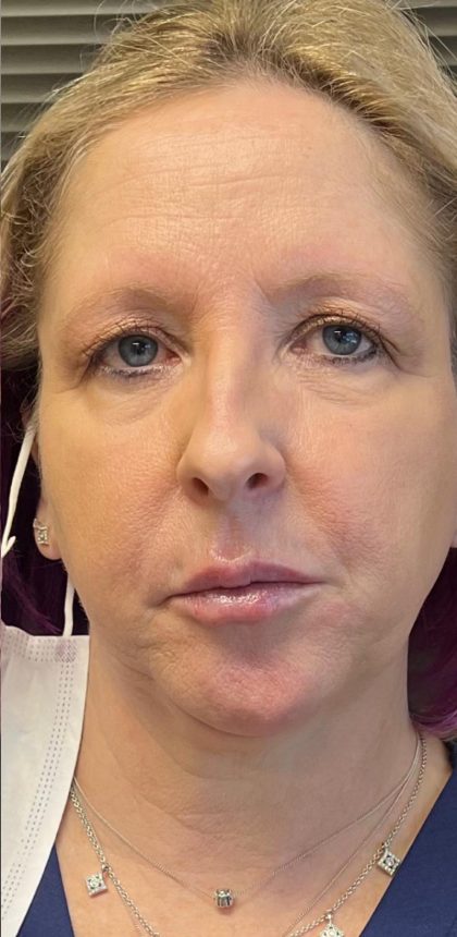 Botox & Fillers Before & After Patient #1538