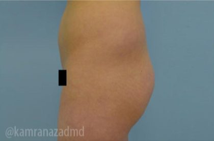 Brazilian Butt Lift Before & After Patient #1692