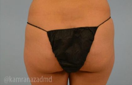 Brazilian Butt Lift Before & After Patient #1739