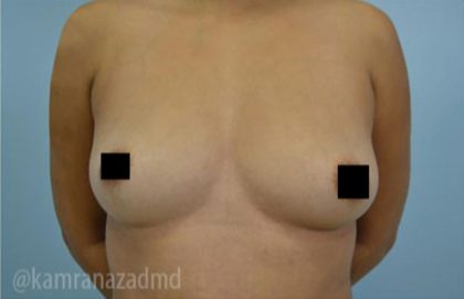 Breast Augmentation Before & After Patient #2158