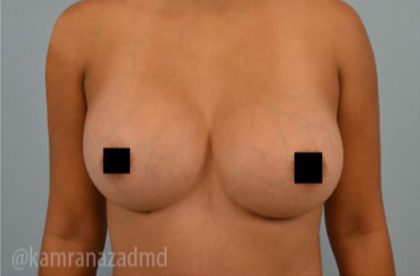 Breast Augmentation Before & After Patient #2158