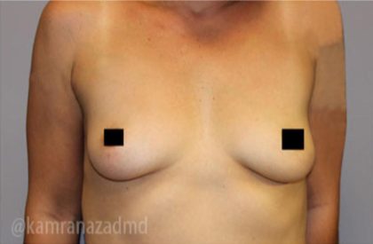 Breast Augmentation Before & After Patient #2162