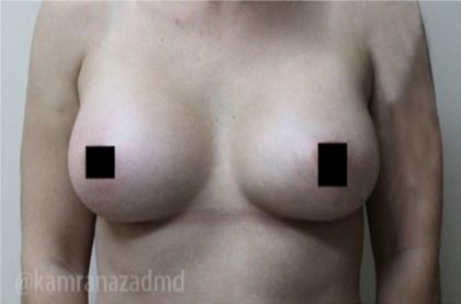 Breast Augmentation Before & After Patient #2162