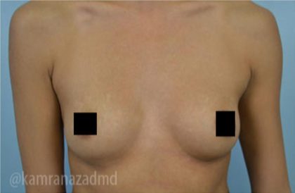 Breast Augmentation Before & After Patient #2160