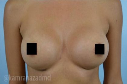 Breast Augmentation Before & After Patient #2160