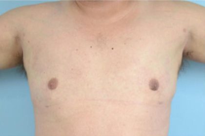 Gynecomastia Before & After Patient #2322