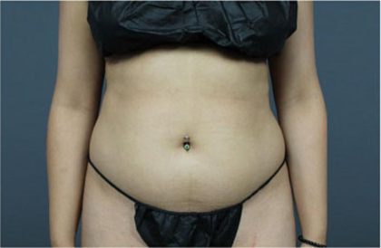 Liposuction Before & After Patient #2882