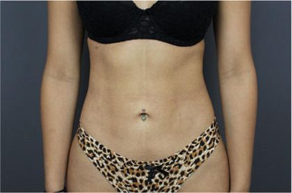 Liposuction Before & After Patient #2882