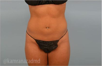 Liposuction Before & After Patient #2884