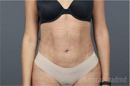 Liposuction Before & After Patient #2892