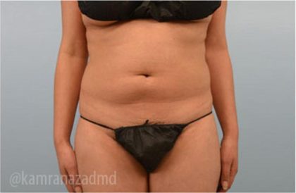 Liposuction Before & After Patient #2895