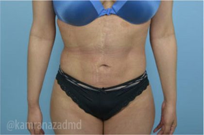 Liposuction Before & After Patient #2895