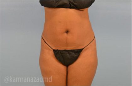 Liposuction Before & After Patient #2897