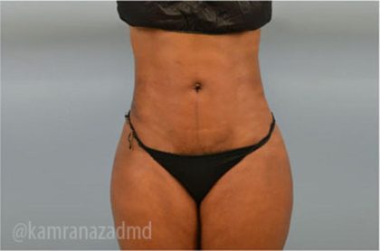 Liposuction Before & After Patient #2897