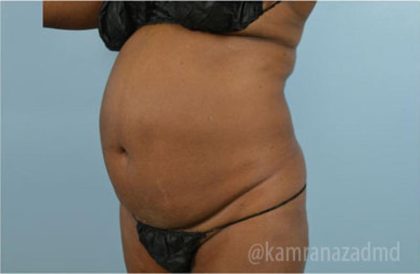 Liposuction Before & After Patient #2899