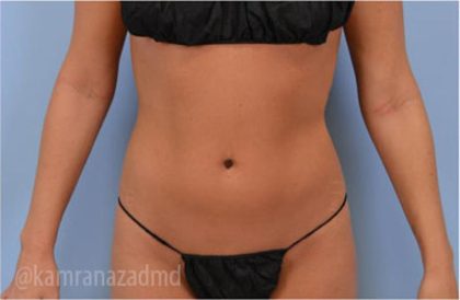 Liposuction Before & After Patient #2903