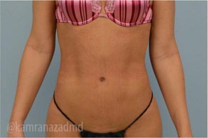 Liposuction Before & After Patient #2903