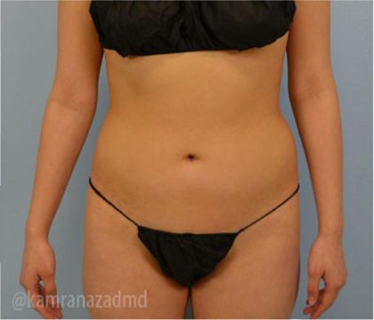 Liposuction Before & After Patient #2874