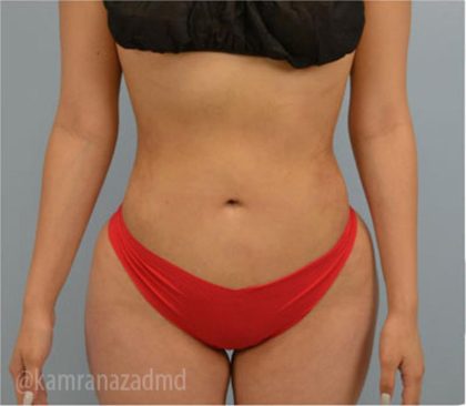 Liposuction Before & After Patient #2874