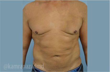Male Liposuction Before & After Patient #2919