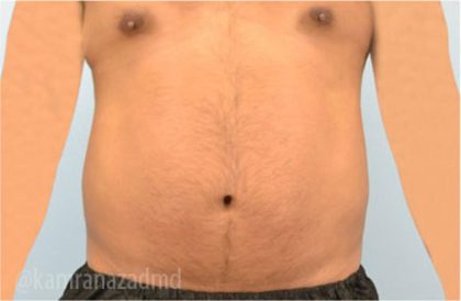 Male Liposuction Before & After Patient #2920