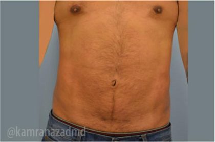 Male Liposuction Before & After Patient #2920