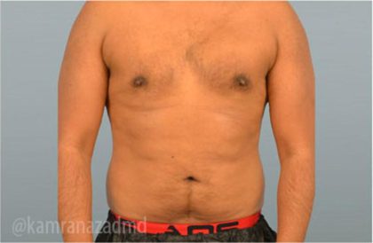 Male Liposuction Before & After Patient #2921