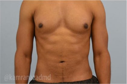 Male Liposuction Before & After Patient #2923