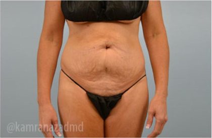 Tummy Tuck Before & After Patient #2869