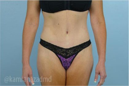 Tummy Tuck Before & After Patient #2869