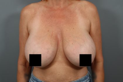 Breast Lift Before & After Patient #3202