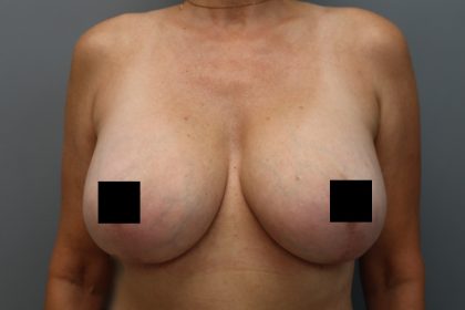 Breast Lift Before & After Patient #3202