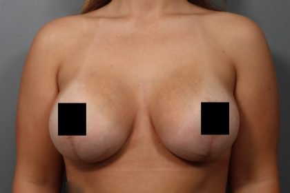 Breast Lift Before & After Patient #3187