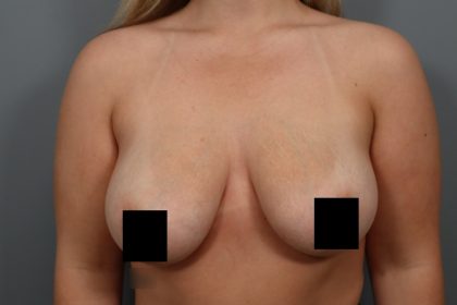 Breast Lift Before & After Patient #3187